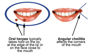 Bump on corner of mouth phrase... consider Bump on corner of mouth